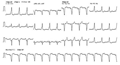 27 Year-Old Female With Episodes Of Palpitations