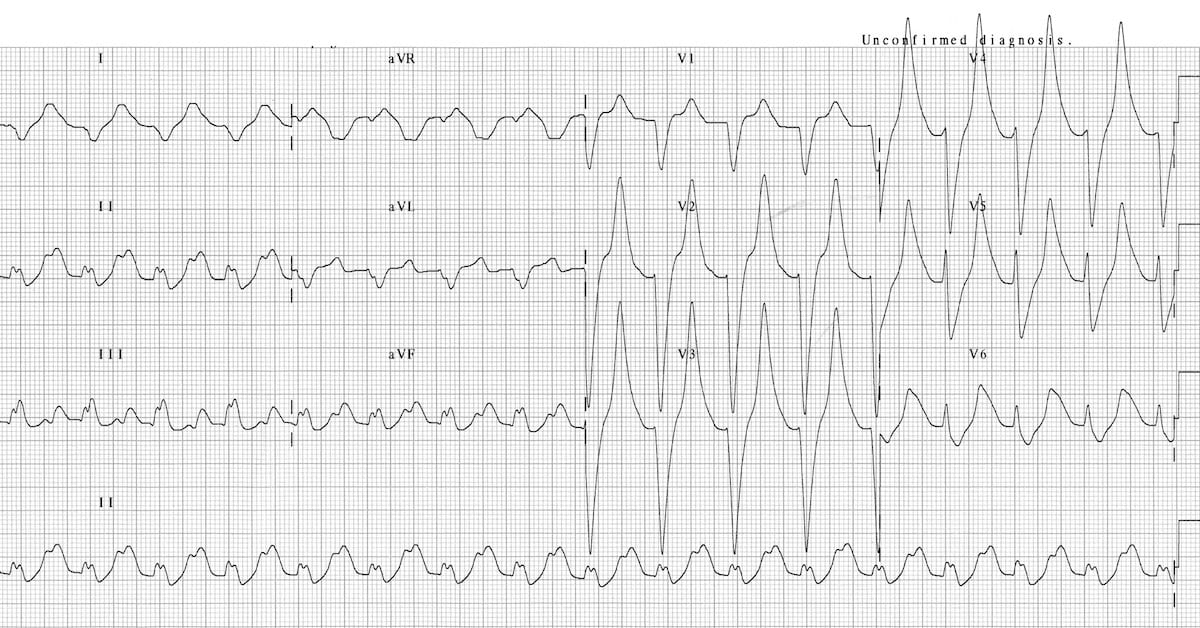 ECG with prolonged QRS peaked T-waves, flattened P-wave.
