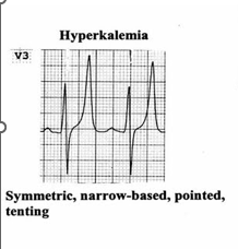 Hyperkalemia and tall T-waves